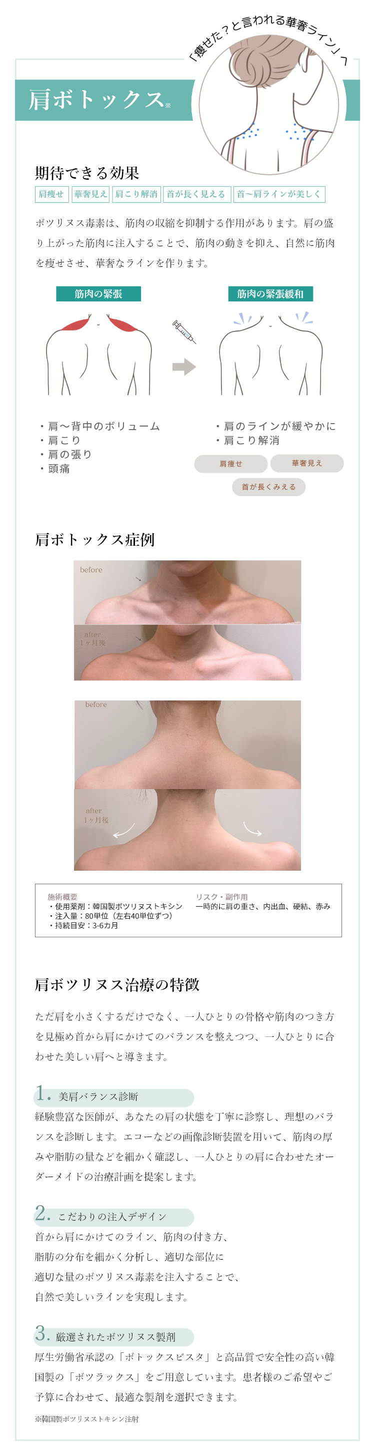 肩ボトックス