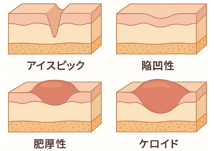 【医師監修】ニキビ跡撃退作戦:ニキビ跡ポテンツァで滑らか肌へ