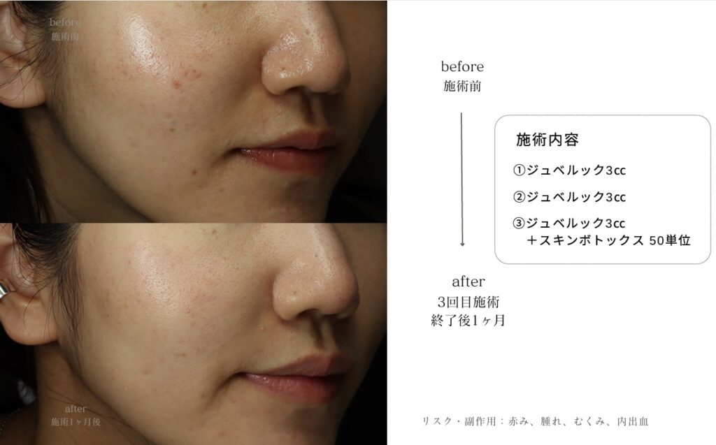 ボライト、ジュベゲル注射なら0th CLINIC|肌育・保湿注射