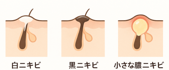面皰圧出(ニキビ圧出)|0th CLINIC 日本橋 保険診療