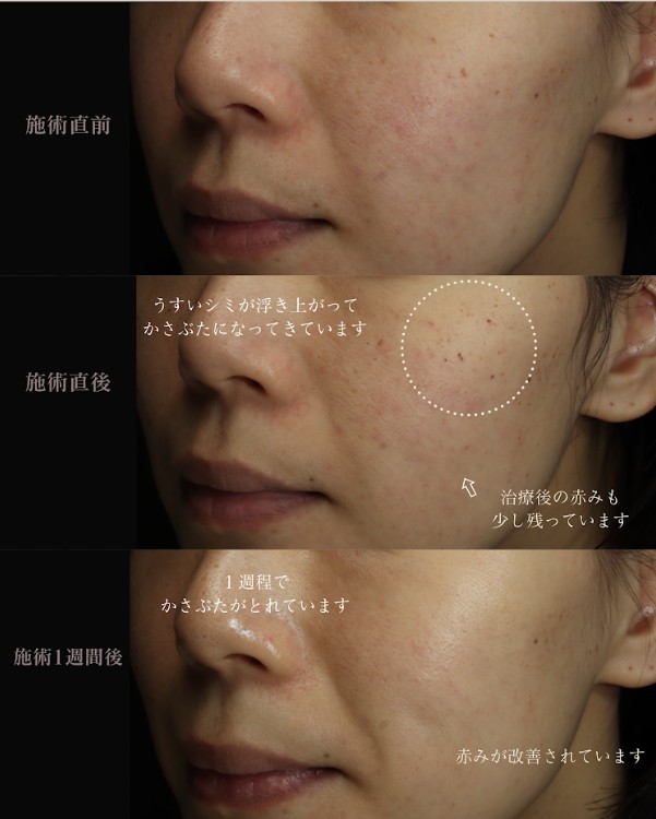 ルメッカ治療｜シミ・赤み・毛穴を同時に改善｜0th CLINIC 日本橋