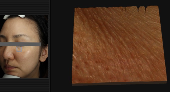 【最新肌診断】VISIA（ビジア）による肌解析