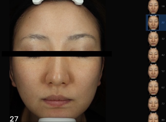 【最新肌診断】VISIA（ビジア）による肌解析