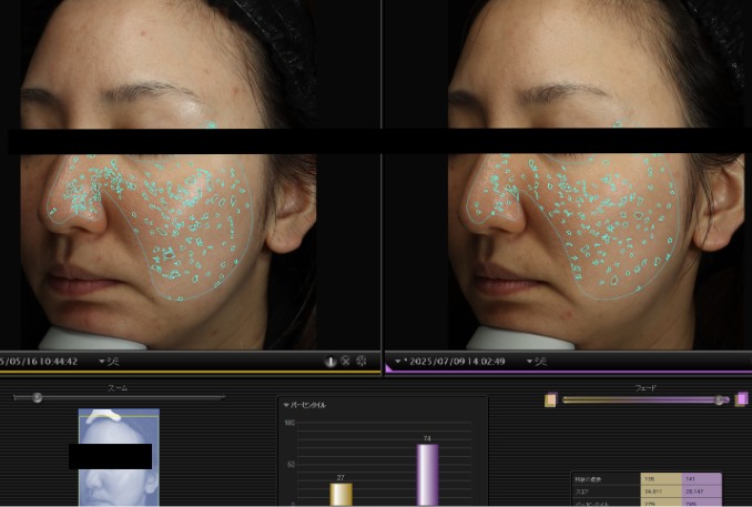 【最新肌診断】VISIA（ビジア）による肌解析