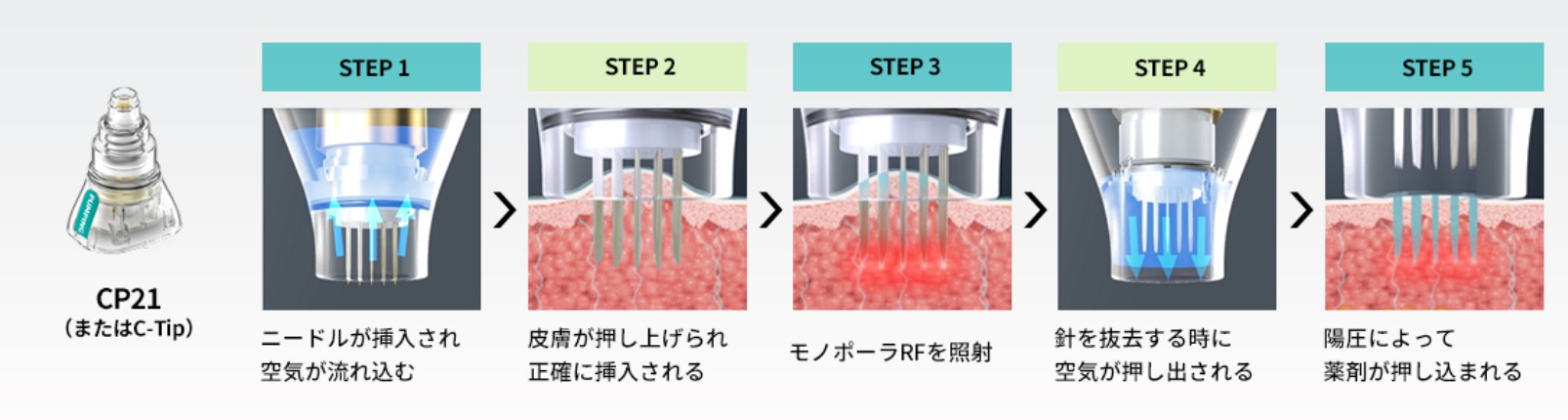 ポテンツァ（RFマイクロニードル）｜ニキビ跡・毛穴・たるみ改善