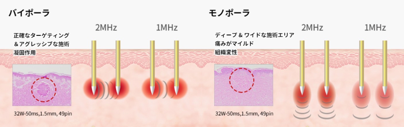 ポテンツァ（RFマイクロニードル）｜ニキビ跡・毛穴・たるみ改善