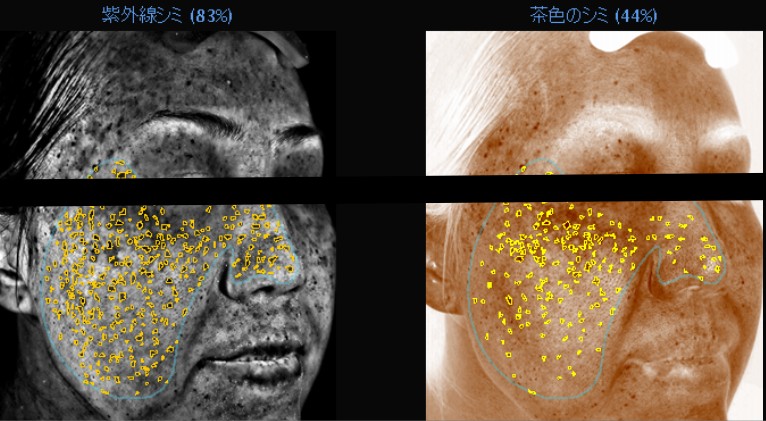 肝斑（かんぱん）の診断と初期プラン｜日本橋・東京駅すぐの皮膚科