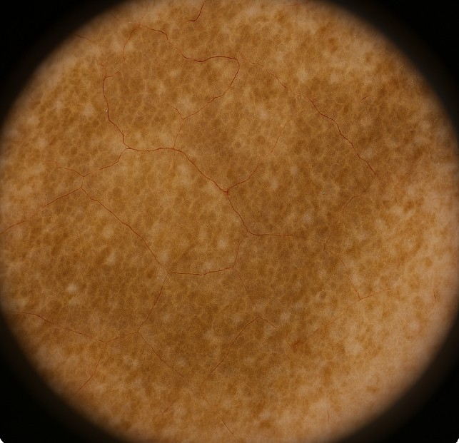 肝斑（かんぱん）の診断と初期プラン｜日本橋・東京駅すぐの皮膚科