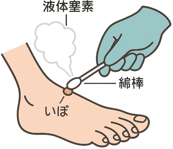 液体窒素治療(冷凍凝固)|いぼ・尖圭コンジローマ・日光角化症