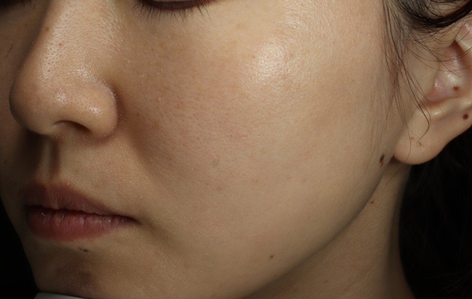 しみ症例写真（撮影条件・個人差の注記）