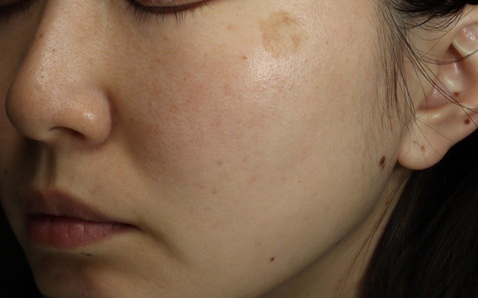 しみ症例写真（撮影条件・個人差の注記）