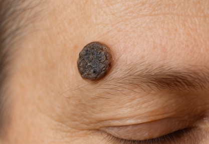 脂漏性角化症(老人性いぼ)