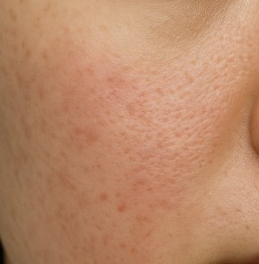 毛穴（開き・黒ずみ・たるみ・詰まり）｜原因別ルートで最短改善