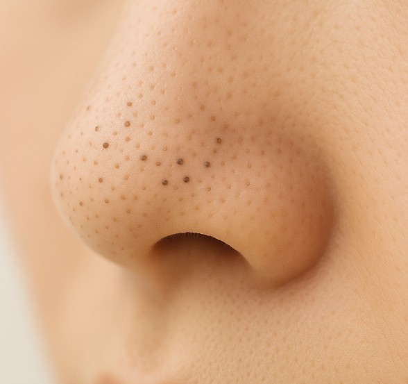 毛穴（開き・黒ずみ・たるみ・詰まり）｜原因別ルートで最短改善