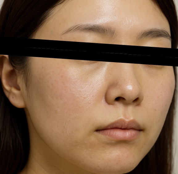 インナードライ（外はテカるのに内はカサつく）｜洗顔・保湿の再設計と90日計画