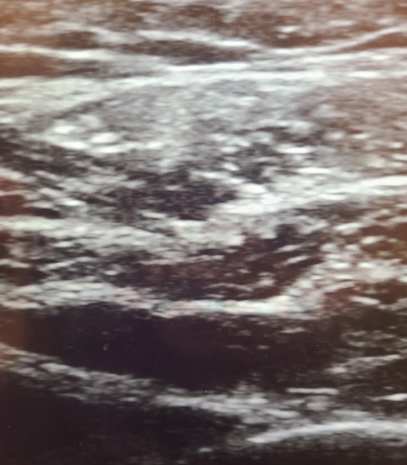 エラ（咬筋）ボトックス｜小顔・食いしばり・頭痛/肩こりにも<br><p style="font-size: 0.25em;">ボトックスは、ボツリヌス菌が作り出した神経毒を精製して作られた薬剤です。正式名称は「ボツリヌス毒素」ですが、アラガン社製の薬剤名が「ボトックス」として広く知られています。 </p> <style>span.post.post-page.current-item p {     display: none; } .ja p {font-size: 10px;line-height: 1.6;"}</style>