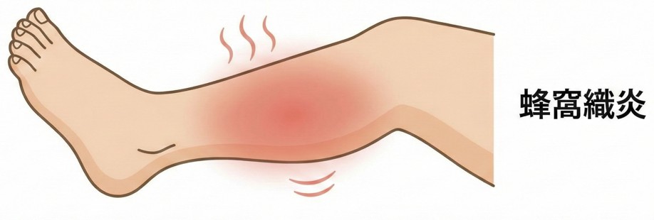 皮膚の感染症（蜂窩織炎・ひょうそ・爪周囲炎など）