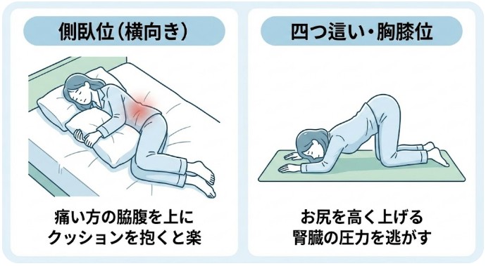 尿管結石（結石の痛み）を今すぐ和らげる｜体位・鎮痛・飲水と受診の目安