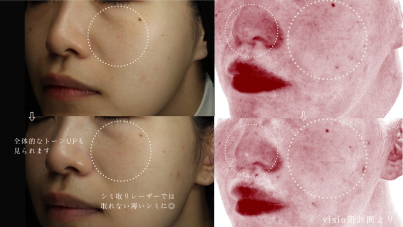 【2026】ルメッカ症例写真と経過解説｜シミ・赤みの改善を可視化