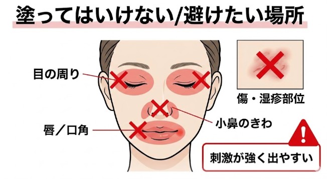 ベピオローションの使い方｜赤み・皮むけを減らす塗り方と注意点（BPO）