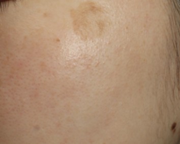 ピコスポット（ピコ秒スポット照射）｜シミ・そばかすをピンポイント治療