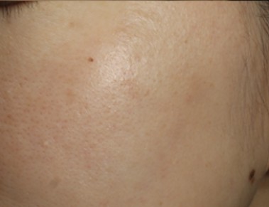 ピコスポット（ピコ秒スポット照射）｜シミ・そばかすをピンポイント治療