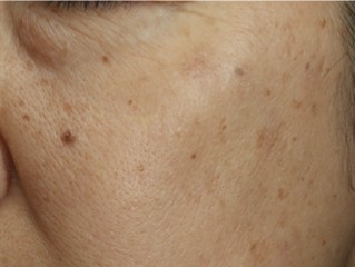 ピコスポット（ピコ秒スポット照射）｜シミ・そばかすをピンポイント治療