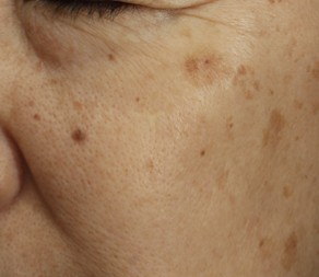 ピコスポット（ピコ秒スポット照射）｜シミ・そばかすをピンポイント治療