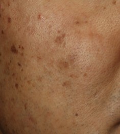 ピコスポット（ピコ秒スポット照射）｜シミ・そばかすをピンポイント治療