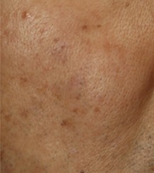 ピコスポット（ピコ秒スポット照射）｜シミ・そばかすをピンポイント治療