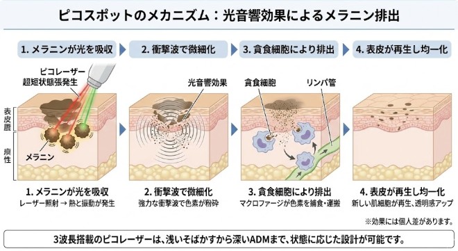 ピコスポット（ピコ秒スポット照射）｜シミ・そばかすをピンポイント治療