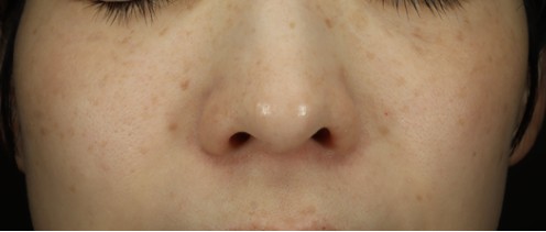 ルビーフラクショナル（694nm）｜くすみ・色ムラ・PIHを均一化