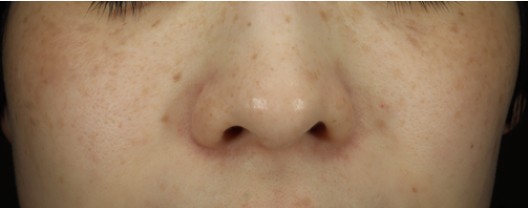 ルビーフラクショナル（694nm）｜くすみ・色ムラ・PIHを均一化