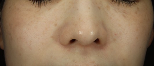 ルビーフラクショナル（694nm）｜くすみ・色ムラ・PIHを均一化