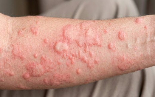 蕁麻疹（じんましん）｜急なかゆみ・ミミズ腫れ・慢性じんましん